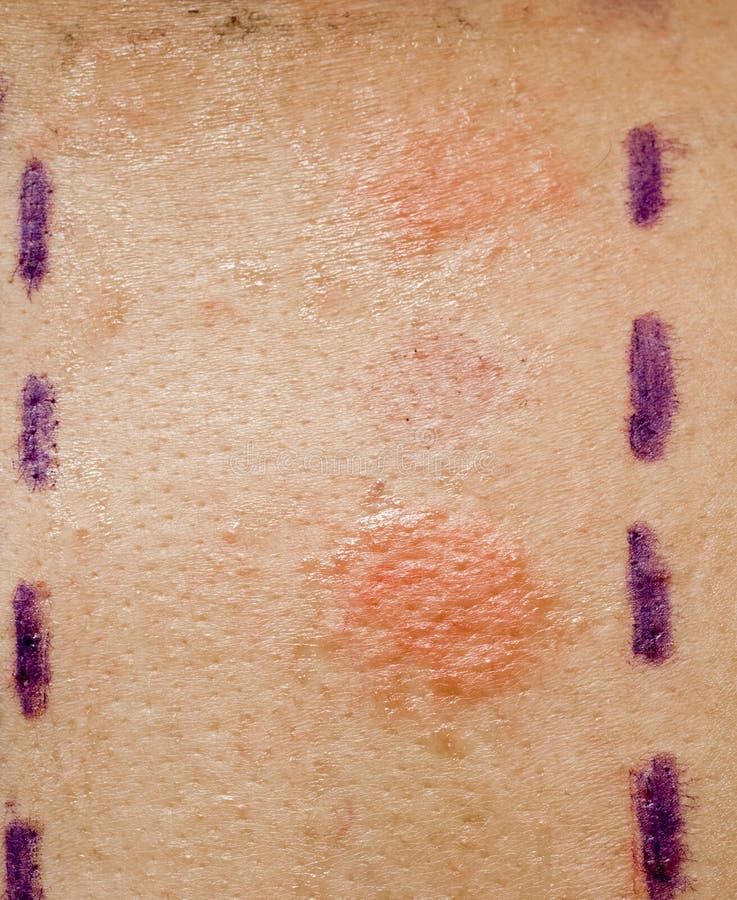 Essai d'allergie de peau photo stock. Image du dermatologique 12922296