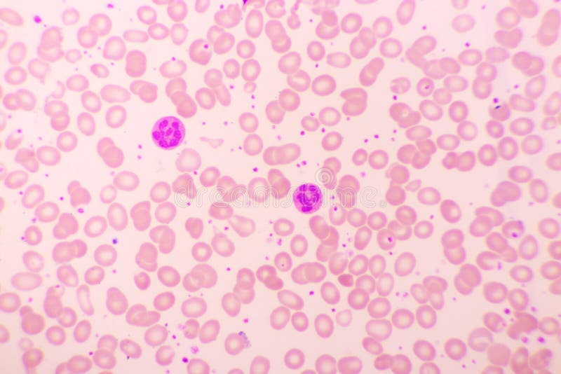 Essential thrombocytosis blood smear