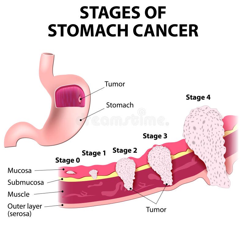 Estacionamiento del cáncer de estómago stock de ilustración Estacionamiento del cáncer de estómago stock de ilustración