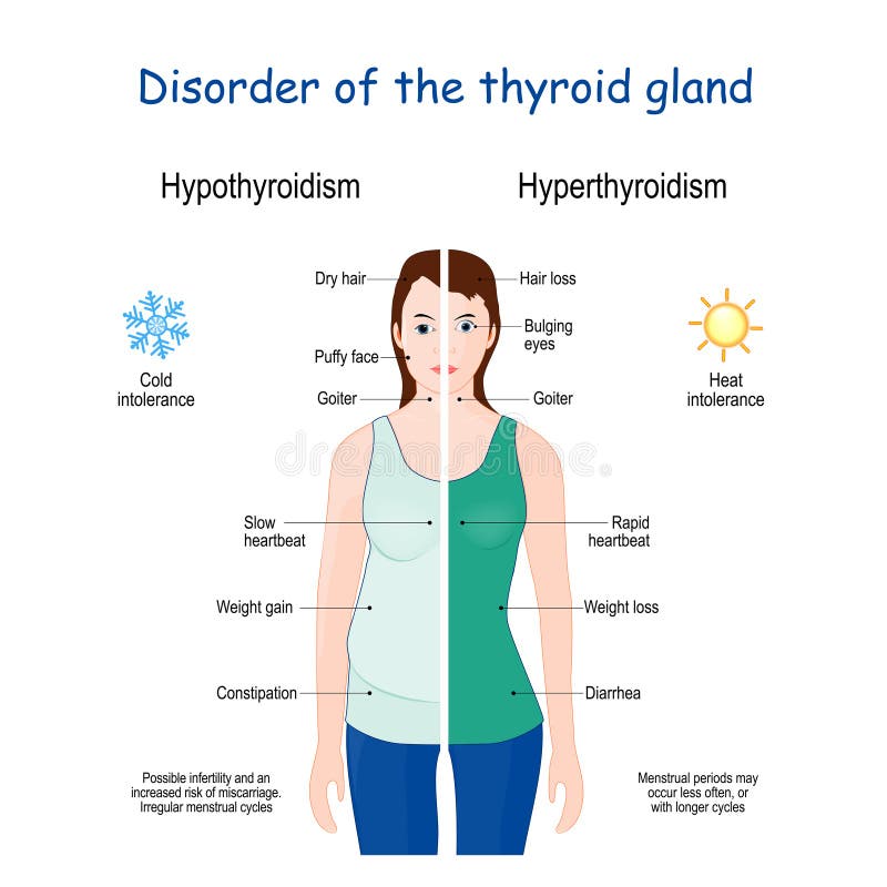 Et hyperthyroïdisme hypothyroïdie. Féminine avec des signes et symptômes des maladies de la glande thyroïde illustration stock