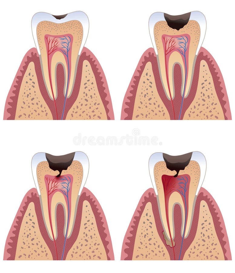 Diagram of tooth with caries stages. Diagram of tooth with caries stages