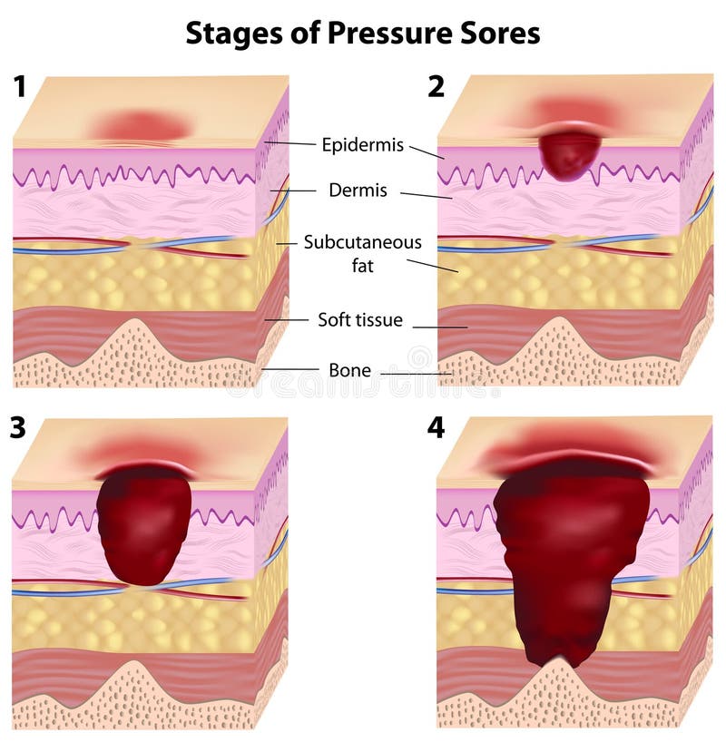 Progression of pressure sores (bed sores), eps8. Progression of pressure sores (bed sores), eps8