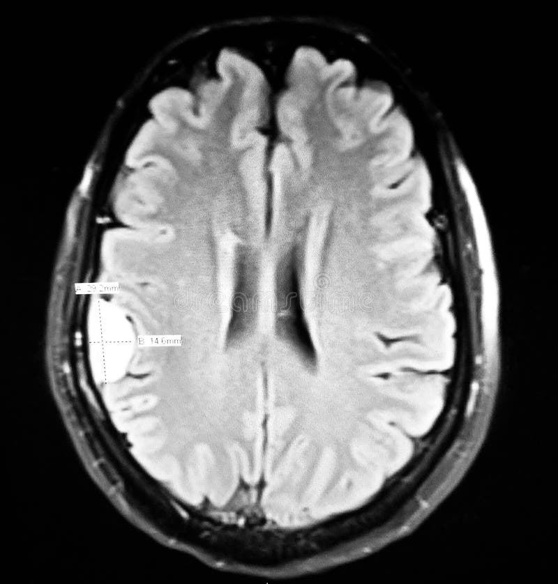 Examen axial supplémentaire de mri de lésion de la masse de convexité de cerveau photographie stock libre de droits Examen axial supplémentaire de mri de lésion de la masse de convexité de cerveau photographie stock libre de droits