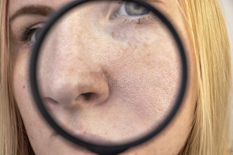 Expanded pores, black spots, acne, rosacea close-up on the nose. A woman is being examined by a doctor. Dermatologist examines the royalty free stock photo Expanded pores, black spots, acne, rosacea close-up on the nose. A woman is being examined by a doctor. Dermatologist examines the royalty free stock photo