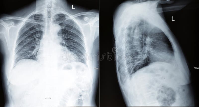 A chest xray scan for a medical diagnosis,front and side. A chest xray scan for a medical diagnosis,front and side