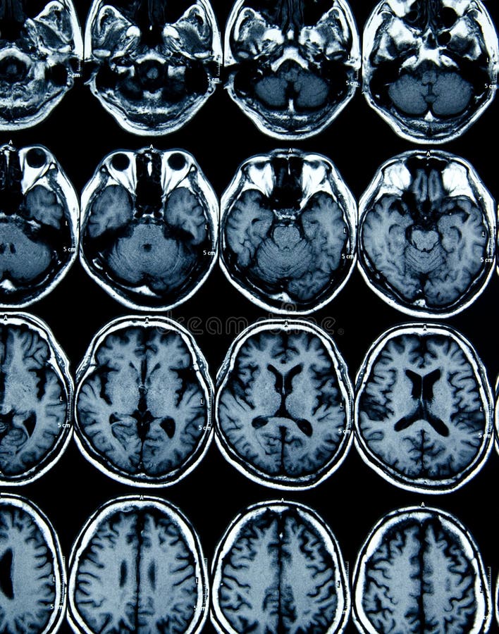 Exploración de MRI del cerebro para la diagnosis imagen de archivo libre de regalías Exploración de MRI del cerebro para la diagnosis imagen de archivo libre de regalías