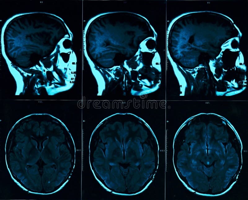 Exploración de resonancia magnética del cerebro con el cráneo Exploración de la cabeza de MRI en color azul del fondo oscuro fotografía de archivo libre de regalías Exploración de resonancia magnética del cerebro con el cráneo Exploración de la cabeza de MRI en color azul del fondo oscuro fotografía de archivo libre de regalías