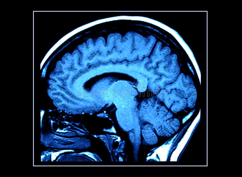 Exploración del cerebro de MRI