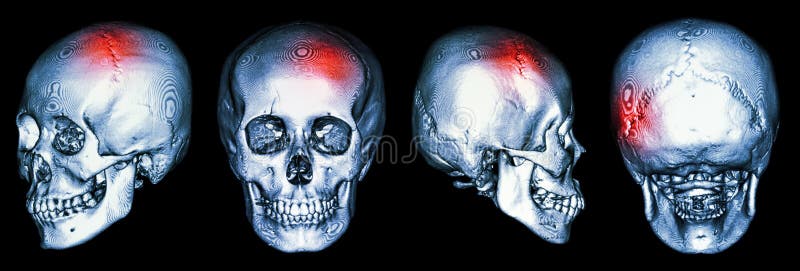 Exploración del CT del cráneo humano y de 3D con el movimiento (accidente cerebrovascular) fotografía de archivo Exploración del CT del cráneo humano y de 3D con el movimiento (accidente cerebrovascular) fotografía de archivo