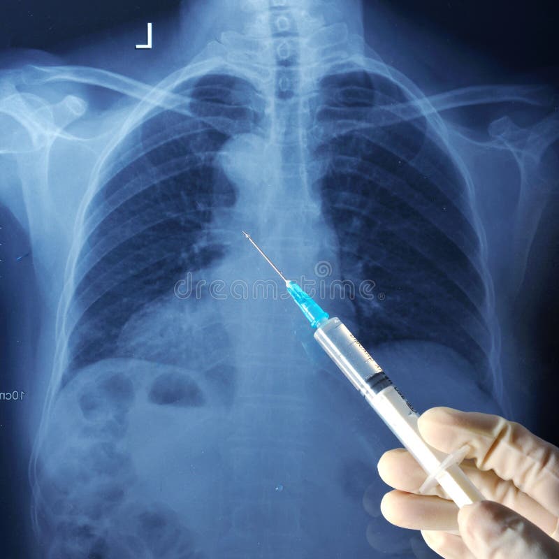 Doctor holding a syringe on Chest CT scan. Doctor holding a syringe on Chest CT scan