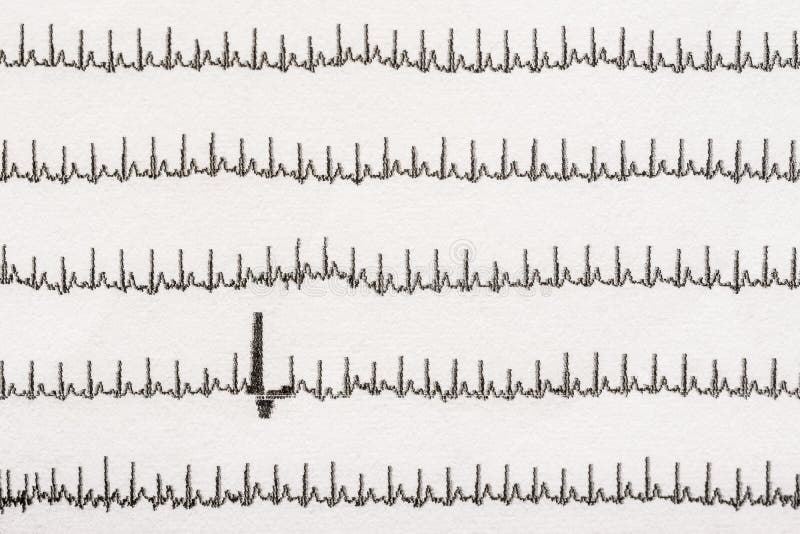 Extrasystole On Electrocardiogram Stock Image Image 38663433