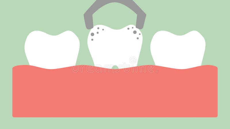 Extração por ferramentas dentais, dente do dente de deterioração da remoção