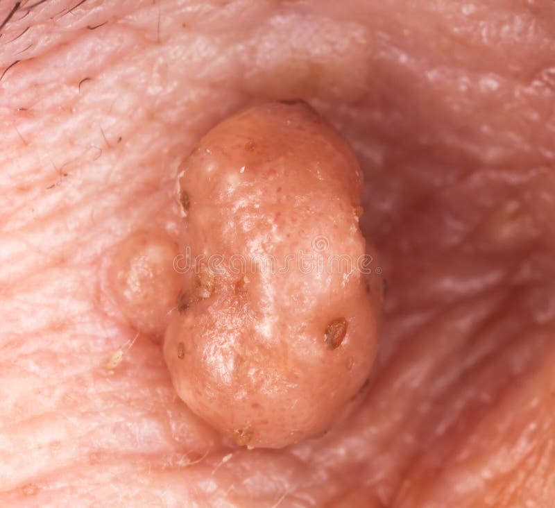 Extreme close-up of a wart. stock images