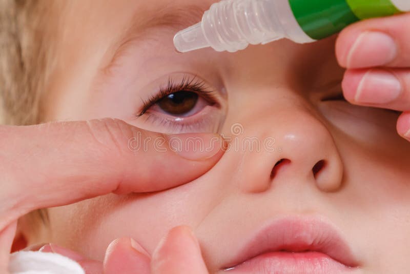 Eye child allergy and conjunctivitis red allergic,  medicine