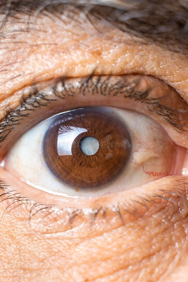 Eye of an elderly man with cataracts, clouding of the lens, macro.