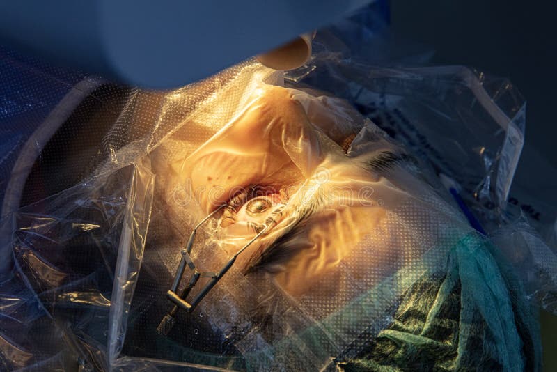 Eye Surgery Process, Treatment of Cataract and Diopter Correction