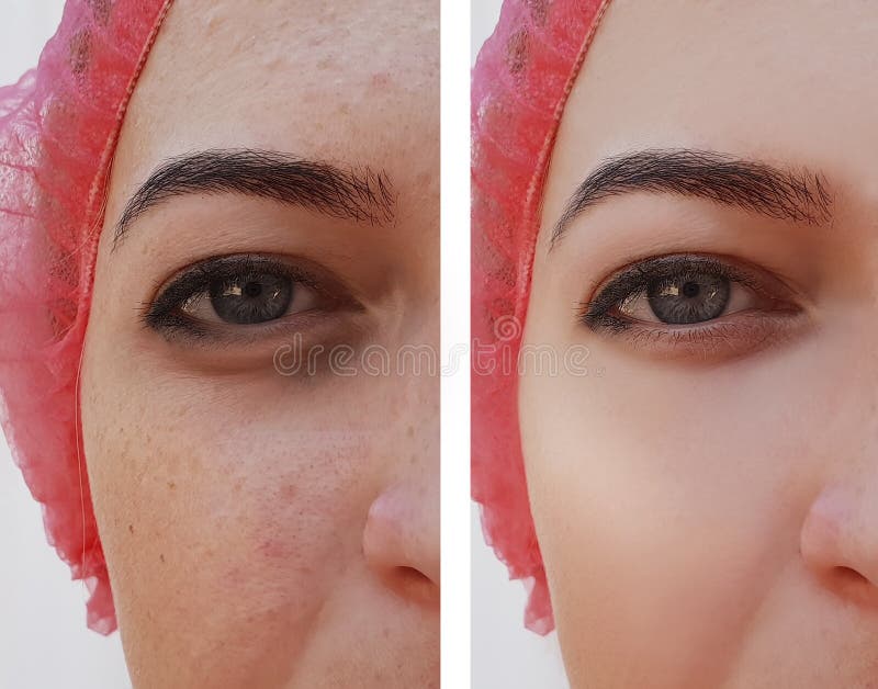 Eye swelling, wrinkles before and after cosmetic pigmentation procedure royalty free stock photography
