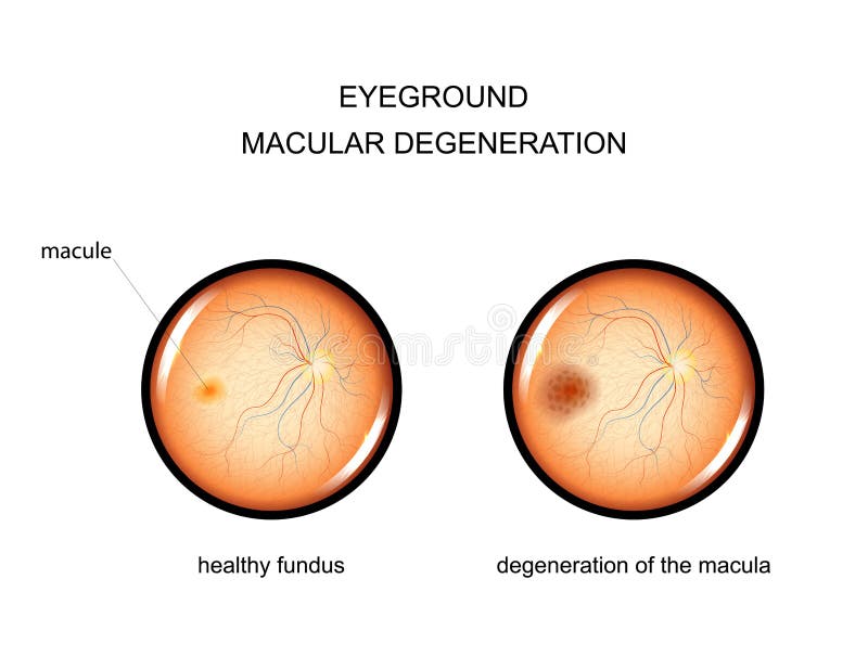 Eyeground degenerazione della macula illustrazione di stock Eyeground degenerazione della macula illustrazione di stock