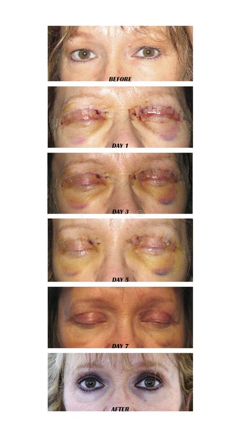 All About Eyelid Surgery Cost and Procedure - Texas Eye and Cataract