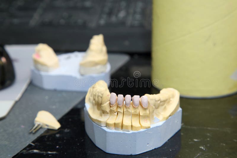 Fabrication of Dental Crowns and Dentures Made of Ceramic. Ceramic Dental Crowns for Implants