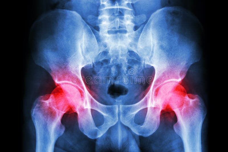 Faccia i raggi x del bacino e dell'artrite dell'essere umano agli entrambi articolazione dell'anca (gotta, reumatoidi)