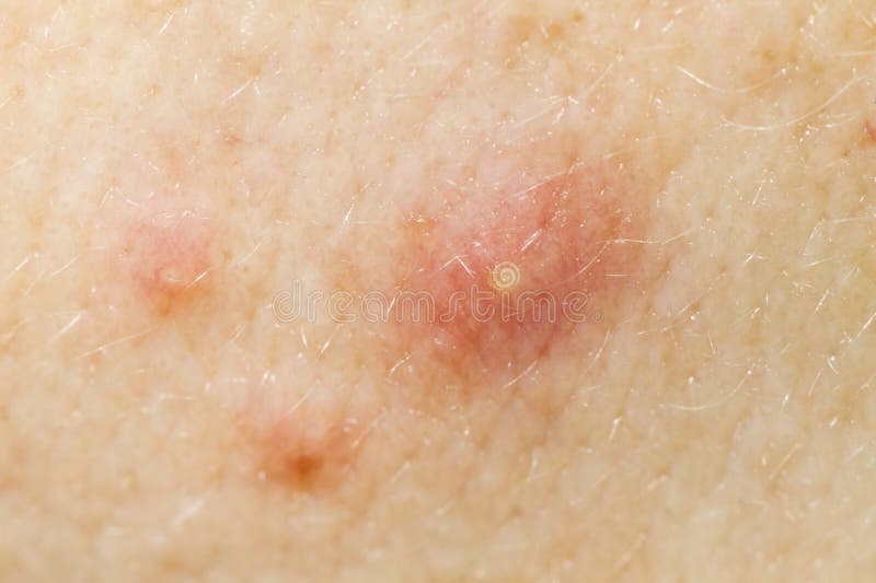 Face Acne Macro royalty free stock image Face Acne Macro royalty free stock image