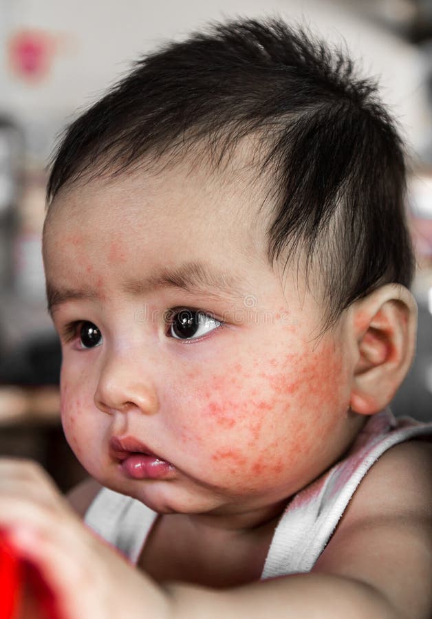 Newborn Rash On Face