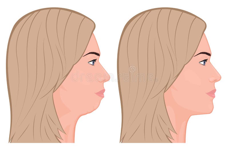 Face side view_Chin Augmentation 1