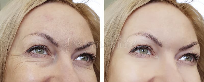 Face woman wrinkles before and after stock photography Face woman wrinkles before and after stock photography