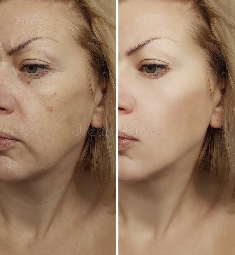 Face woman wrinkles before and after procedure revitalization