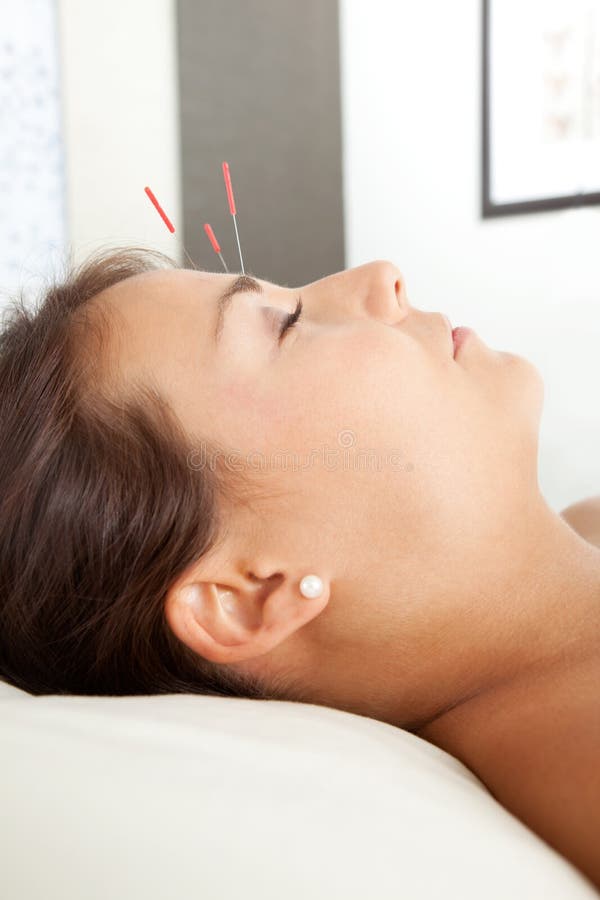 Facial acupuncture stock image. Image of acupuncture 20710739