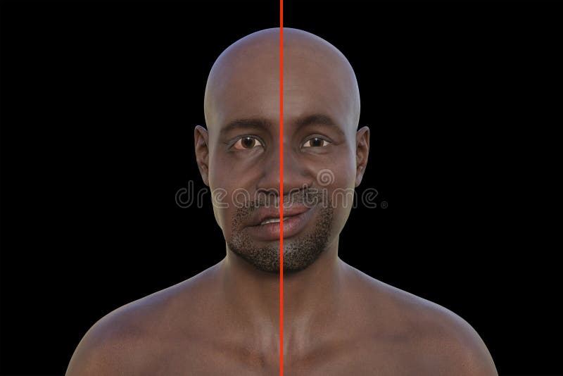 Facial Palsy in an African Man, 3D Illustration Highlighting the ...