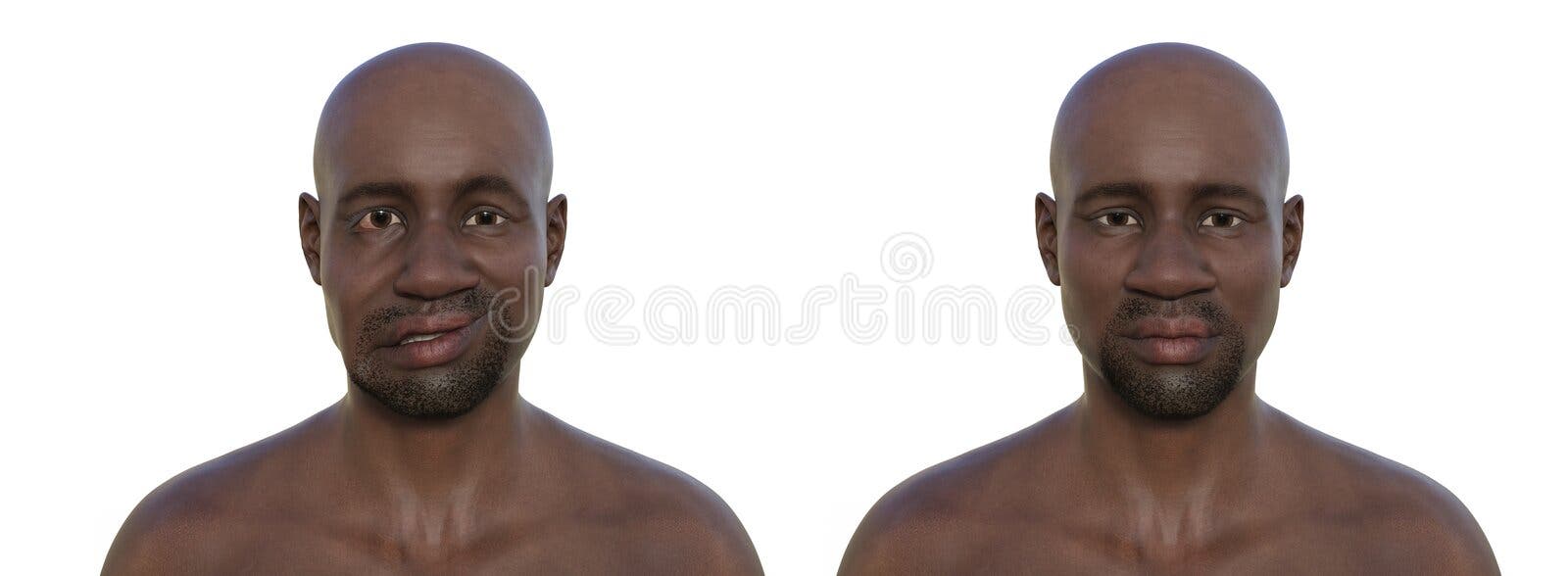 Facial Palsy in a Man, 3D Illustration Highlighting the Asymmetry and