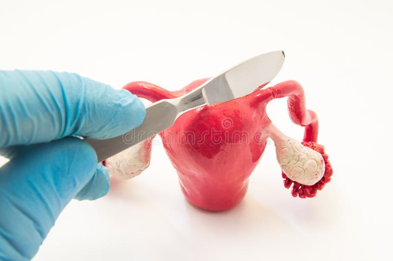 Fallopian tube surgery for treat infertility or ectopic pregnancy photo concept. Doctor`s hand with a scalpel is above the anatomical model of the uterus with fallopian tubes and ovaries