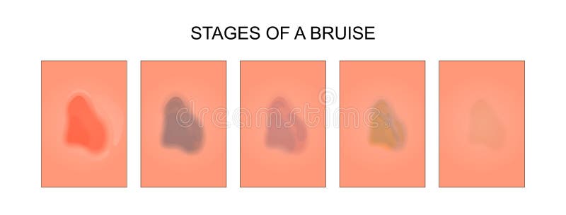 Fases da cura de uma equimose ilustração do vetor Fases da cura de uma equimose ilustração do vetor