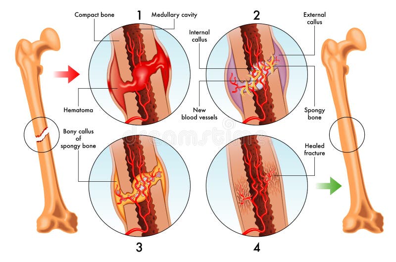 Fases do reparo da fratura de osso