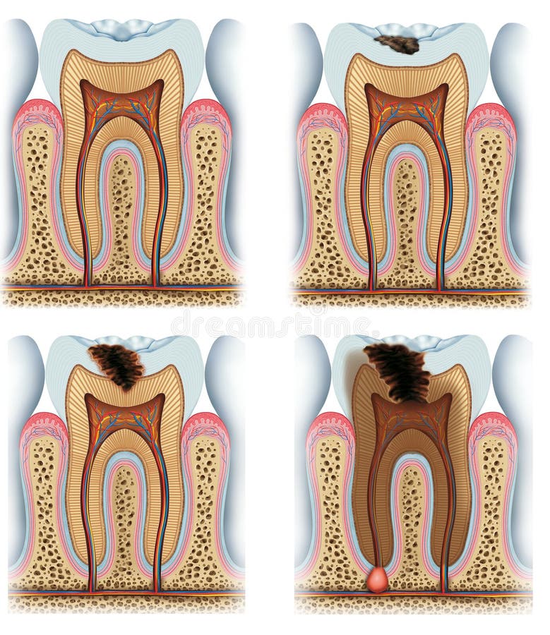 Process evolution and decay of a tooth. Process evolution and decay of a tooth