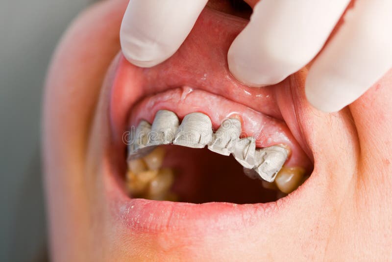 Fast delvis skyddstillsyn för tandprotes