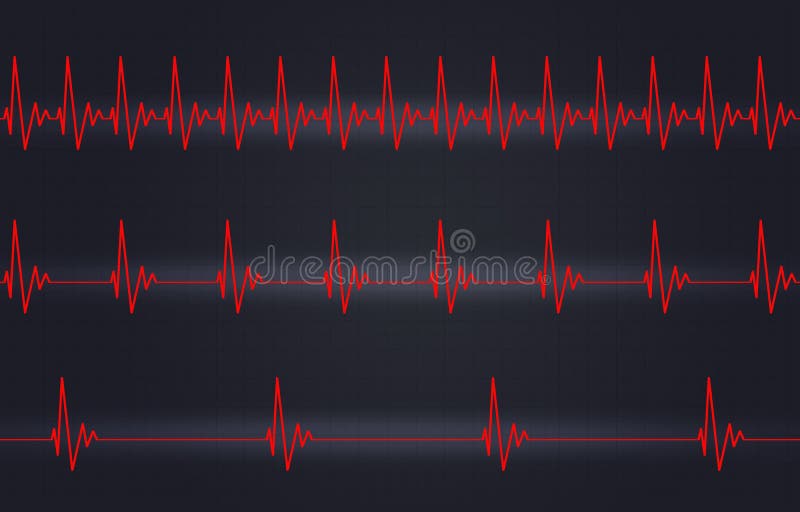 Fast Normal Slow Heartbeat Illustration