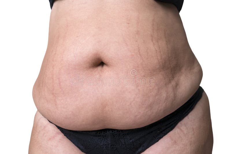 Stretch Marks on a Large Natural Breasts, Obese Woman with Big Boobs, Overweight  Female Body, before and after Concept Stock Image - Image of beauty, chest:  119867327