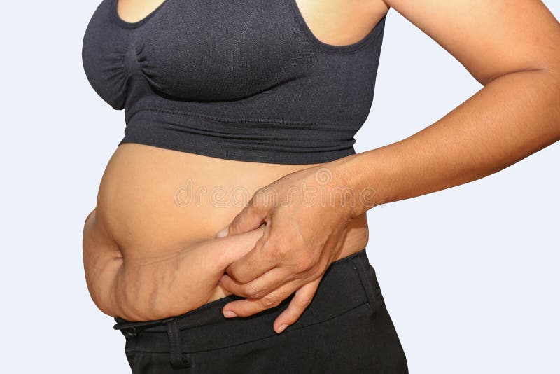 Female hanging belly with stretch marks on skin closeup. Overweight woman  flaunt figure Stock Photo by burmistrovaiuliia