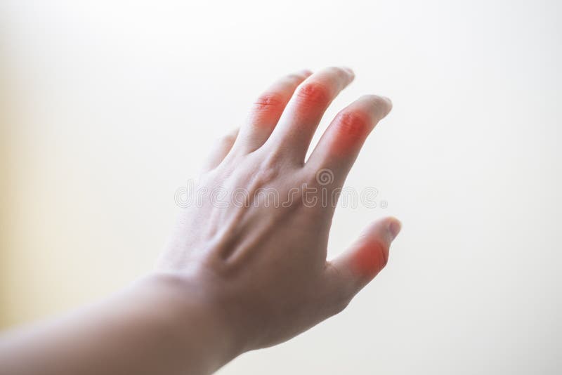 Feche acima do pateint da artrite reumatoide da mão imagens de stock Feche acima do pateint da artrite reumatoide da mão imagens de stock