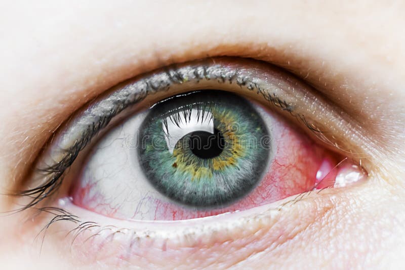 Olhos Irritados De Uma Menina Que Ficasse Doente Com Conjuntivite Foto de Stock - Imagem de adolescente, inchado: 146506816