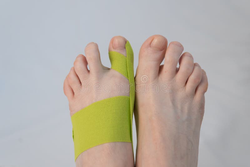 Feet close-up, top view. There is a tap on the big toe. Correction of finger deformity. Hallux valgus. Innovative