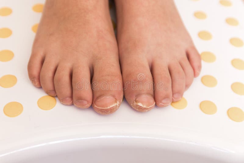 Toenail falling off: What to do, causes, and removal