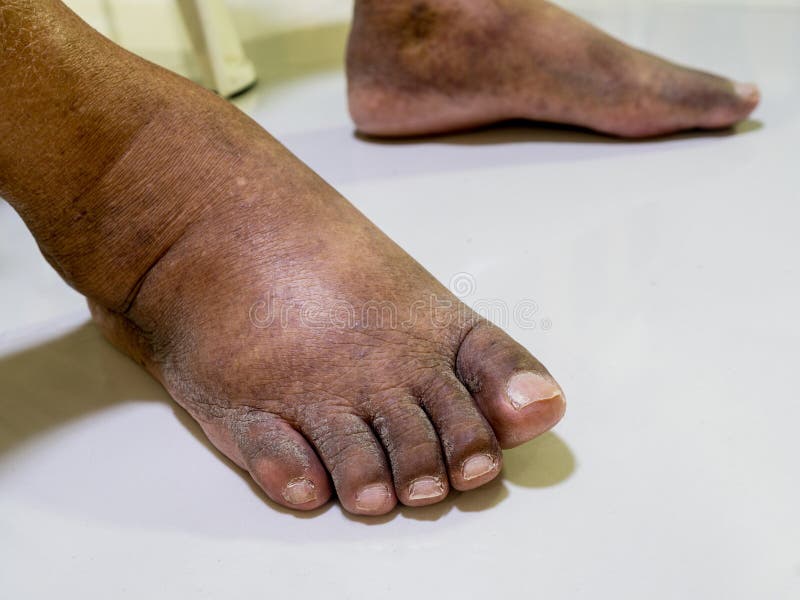 The feet of people with diabetes, dull and swollen. stock images The feet of people with diabetes, dull and swollen. stock images
