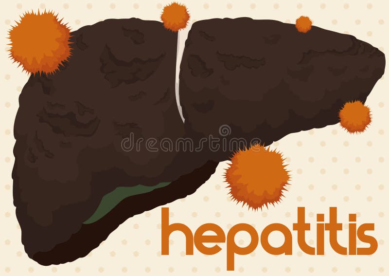Fegato nell'ambito dell'attacco dal virus dell'epatite, illustrazione di vettore illustrazione vettoriale Fegato nell'ambito dell'attacco dal virus dell'epatite, illustrazione di vettore illustrazione vettoriale
