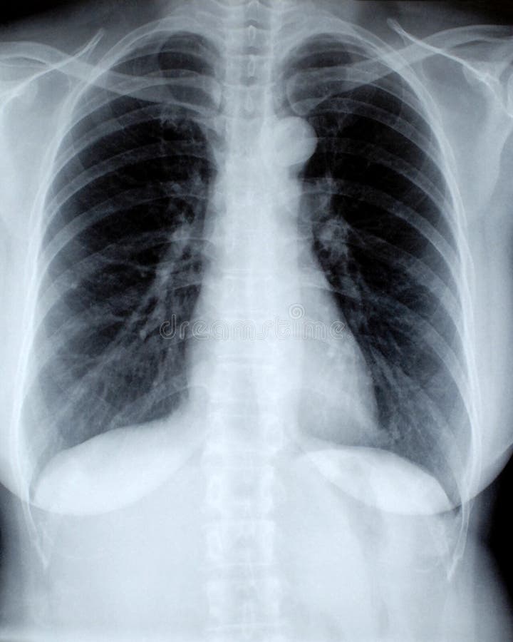 Female chest xray, front view