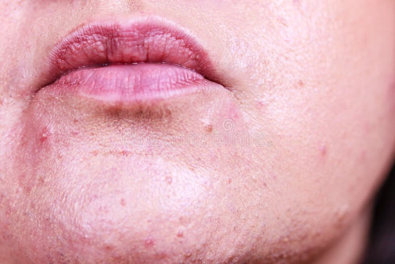 Female face with acne skin problem stock photos Female face with acne skin problem stock photos
