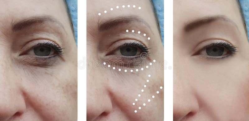 Female Facial Wrinkles Patient Before And After Effect Collage